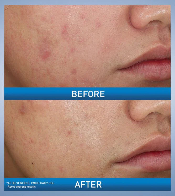 CeraVe Moisturising Cream 340 gram|For Dry To Very Dry Skin